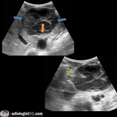 Liver mass mimicking focal nodular hyperplasia on ultrasound : r/Radiology