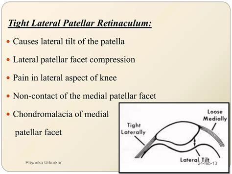 Patellofemoral pain syndrome (pfps) | PPTX