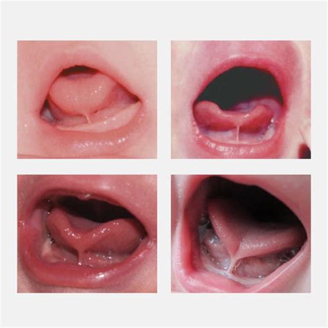 6 Tips to Prevent Mouth Breathing in Infants and Children - Family ...