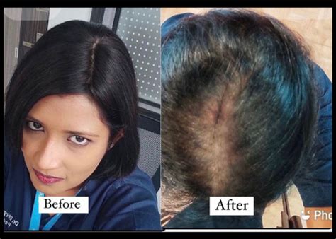 REAL HAIR EXTENSIONS FOR WOMEN | HAIR PATCH BEFORE AFTER COMPARISON ...