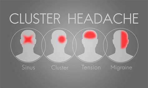 Cluster Headache: Causes, Symptoms & Treatment