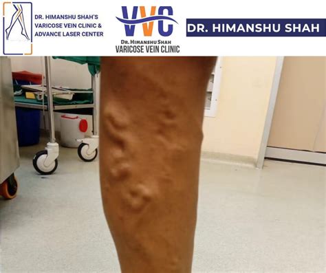 Varicose Vein Treatment Mumbai | Dr Himanshu Shah