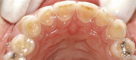 Occlusal veneer restorations may help relieve thermal and biting ...