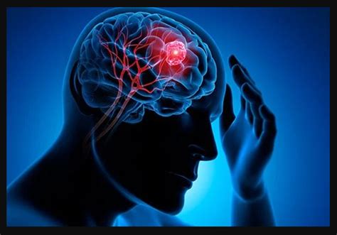 Brain Surgery or Neurosurgery - Heritage Hospital Raipur (C.G)