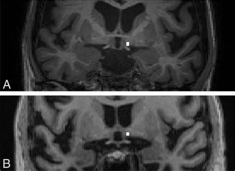 Nucleus Basalis Of Meynert Cross Section