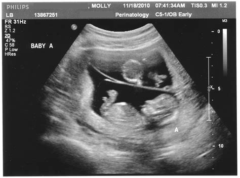 Nuchal Translucency Screening | Daddyhood Transcribed