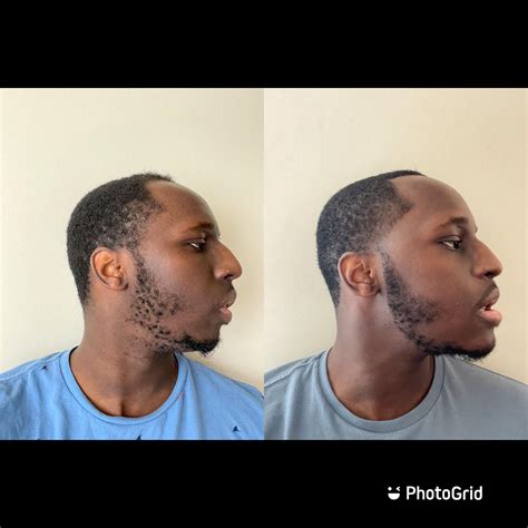 Tips For Double Jaw Surgery at Hamish Payne blog