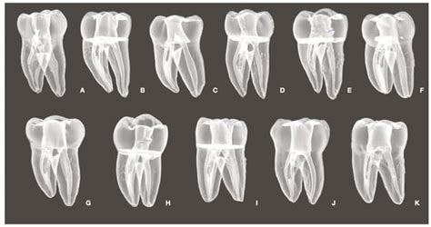 Minimally Invasive Root Canal Cleaning: Evaluating Supplementary ...