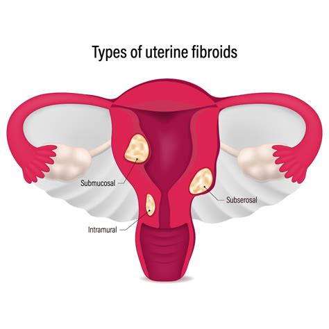 uterine-fibroids-uterus-ufe-illustration-1835148598 | National Vascular Physicians