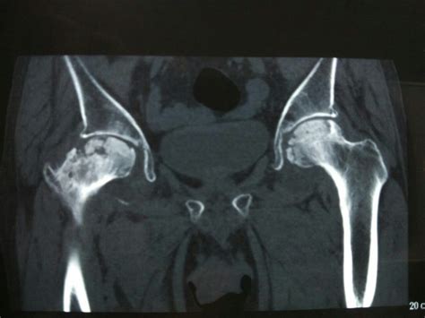 X光片解读股骨头坏死各类分期方法 - 好大夫在线