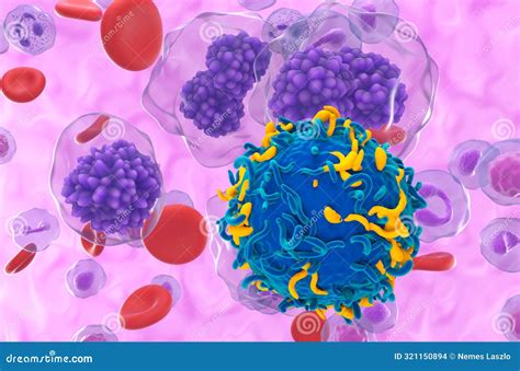 CAR T Cell Therapy in Plasma Cell Leukemia (PCL) - Closeup View 3d Illustration Stock ...
