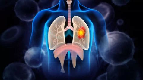 Symptoms of Brain Metastasis: Signs That Lung Cancer Has Spread To Your ...