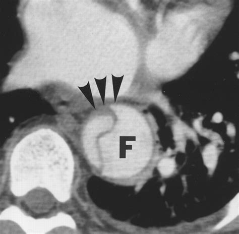 Aortic Dissection CT Features that Distinguish True Lumen from False Lumen | AJR