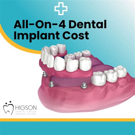 All-on-4 Dental Implant Cost - How Much Does All-On-4 Dental Implants Cost? - Affordable ...