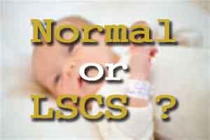 Normal or caesarean section is the choice of a Woman