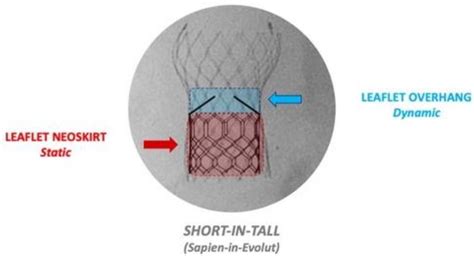 Transcatheter Aortic Valve Implantation to Treat Degenerated Aortic ...