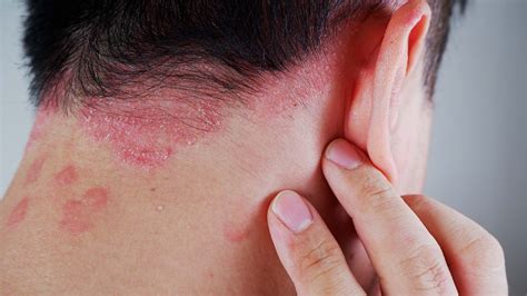 Comprender y tratar la psoriasis – DR.VEGAN