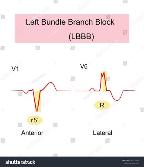 Left Bundle Branch Block Lbbb Ecg Stockvektor (royaltyfri) 1762909052 ...