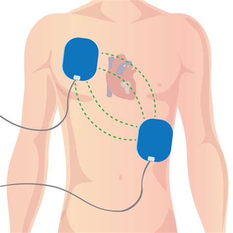 Cardiopulmonary Resuscitation (CPR) | Concise Medical Knowledge