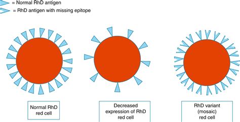 Hemolytic Disease of the Fetus and Newborn - Clinical Tree