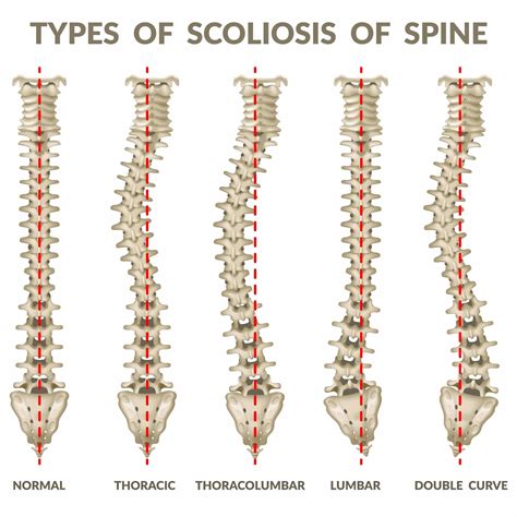 Comprehensive Guide to Understanding Scoliosis | HSRC