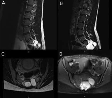 Complex surgical reconstruction for spinopelvic instability caused by a giant Tarlov cyst ...