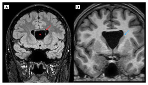 Symptomatic Cavum Septum Pellucidum and Vergae Cyst: A Case Report