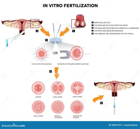 Image result for In Vitro Reproduction