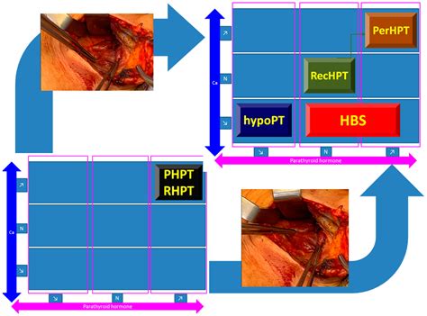 Forestalling Hungry Bone Syndrome after Parathyroidectomy in Patients with Primary and Renal ...