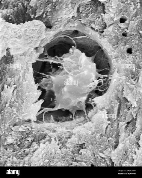 Bone cell (osteocyte) in a bone lacuna from a fractured compact bone ...