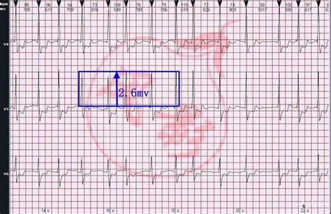 心电图图例分析：心房颤动、完全性右束支合并左前分... 分析测试百科网wiki版