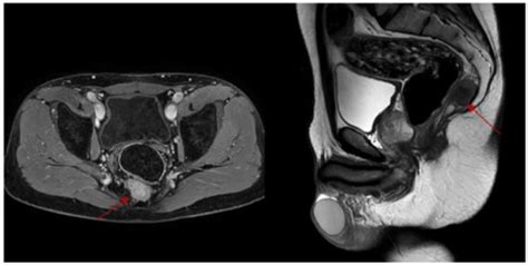 Promoting Laparoscopic Anterior Approach for a Very Low Presacral ...