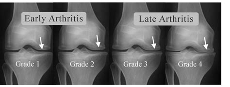 Knee Arthritis Treatment | DR. RAJ KANNA Knee clinic, Chennai