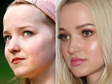 Dove Cameron, Before and After | Dove cameron, Dove cameron lips, Plastic surgery