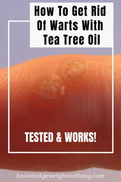 Image result for tea tree oil warts