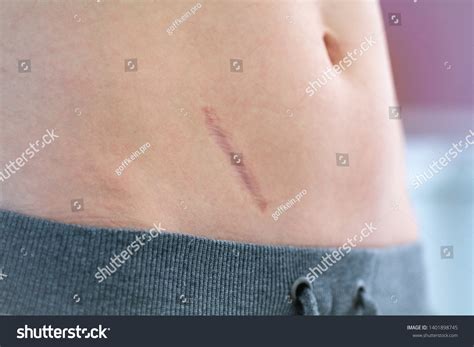 Appendix scar 375 รายการ ภาพ ภาพสต็อกและเวกเตอร์ | Shutterstock