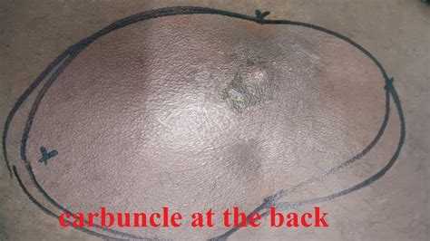 Carbuncle Drainage Procedure 的图像结果