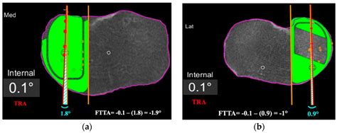 Setting the Tibial Component Rotation Based on Femoral Landmarks Allows Congruent Knee ...