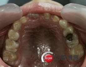 8岁小孩竟长出畸形双排牙，牙医：都是父母的错！