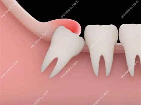 智齿冠周炎张不开嘴几天能好转,慢性与急性智齿冠周炎区别 - 口腔资讯 - 牙齿矫正网