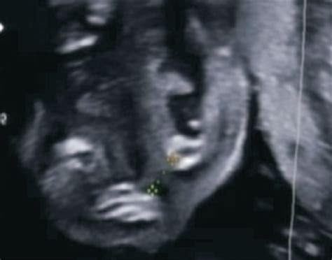 胎儿唇腭裂的影像学特征分析
