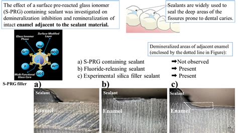 Effect of Surface Pre-Reacted Glass Ionomer Containing Dental Sealant ...