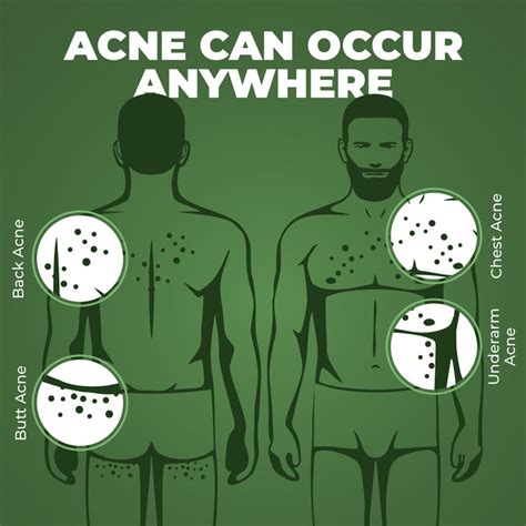 Beardo BODY-ACNE Clear Bodywash (200ml) – Beardo India