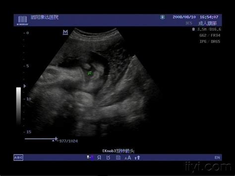 【贴图】清晰的胎儿唇裂，请欣赏 - 超声医学讨论版 - 爱爱医医学论坛