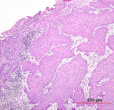 squamous cell carcinoma in situとは: 有棘細胞癌 写真 – YCQRE