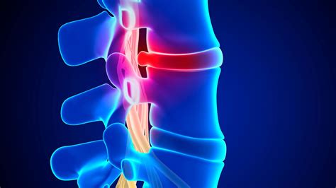 Spinal Tumors - Dr. Symeon Missios, MD