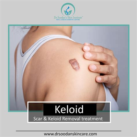 Keloid treatment – Artofit