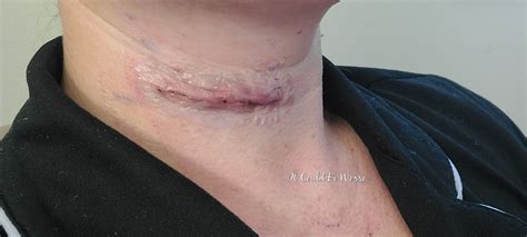 Anterior Cervical Discectomy And Fusion Recovery Time - Infoupdate.org