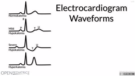 Potassium Ecg Changes at Norma Shanks blog