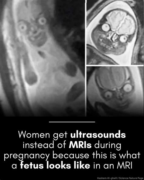 Hashem Al-Ghaili | Why do women get ultrasounds instead of MRIs during pregnancy? This image may ...